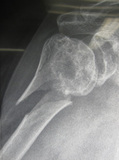 上腕骨subcapital fracture.jpg